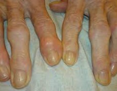 손가락-퇴행성-관절염