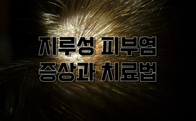  지루성 피부염 증상과 치료법