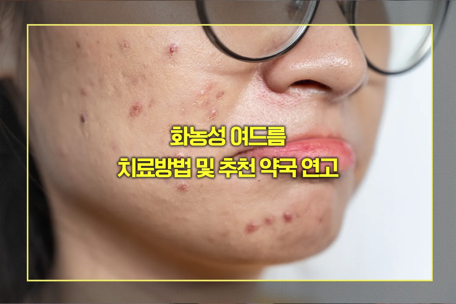 화농성 여드름 치료방법