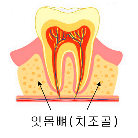 치아를 잡아주는 잇몸뼈인 치조골