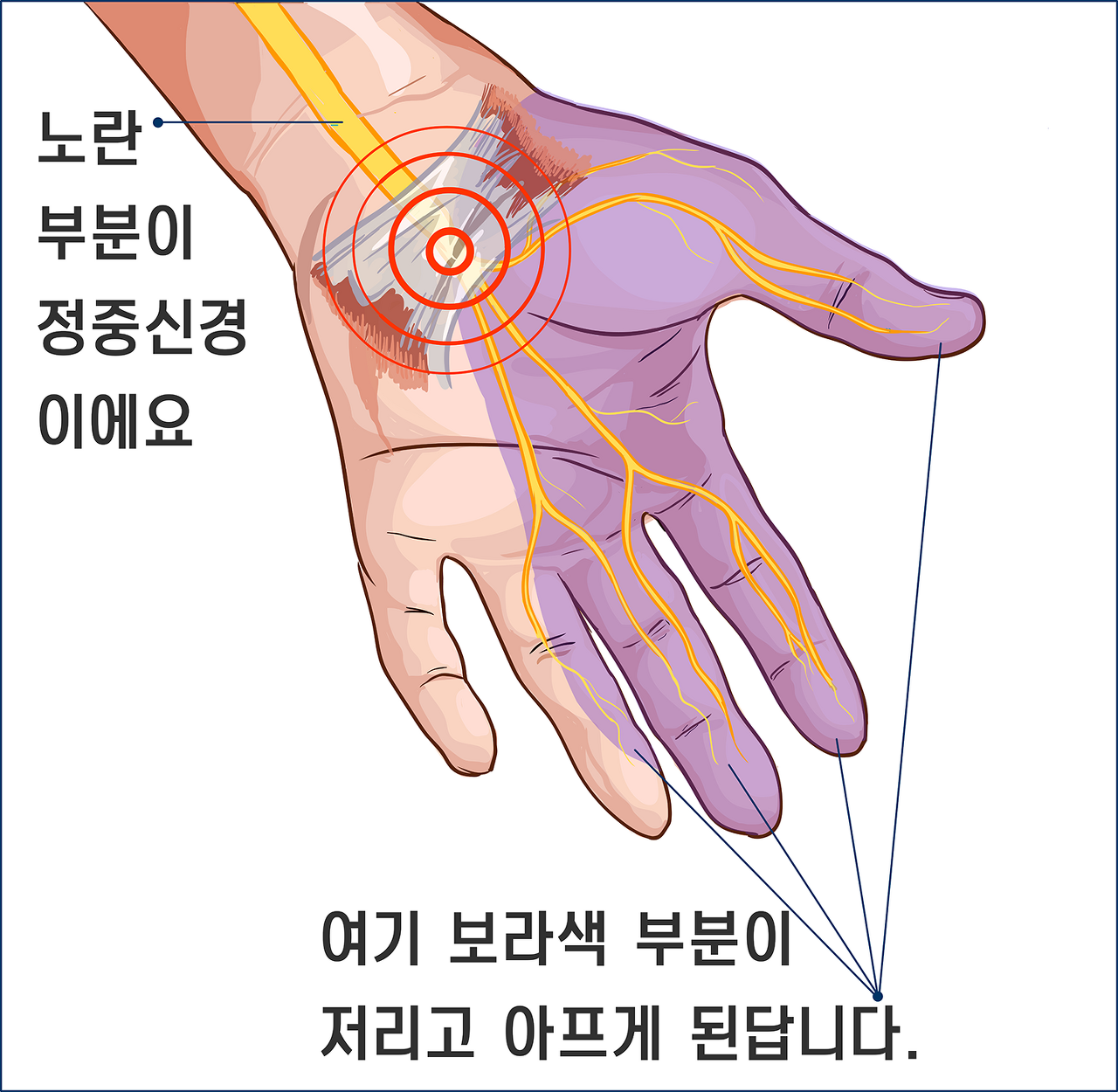 손목통증-손목터널증후군증상