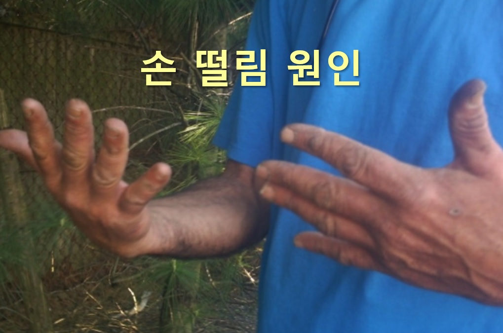  손 떨림 원인과 손 떨림 증상 치료 방법