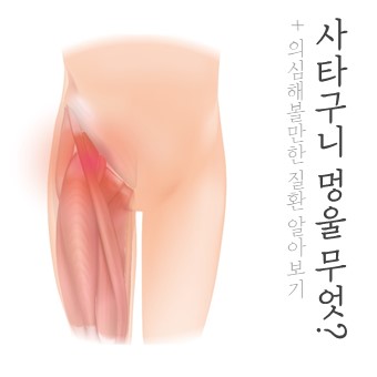  사타구니 멍울 무엇? 의심해볼만한 질환들