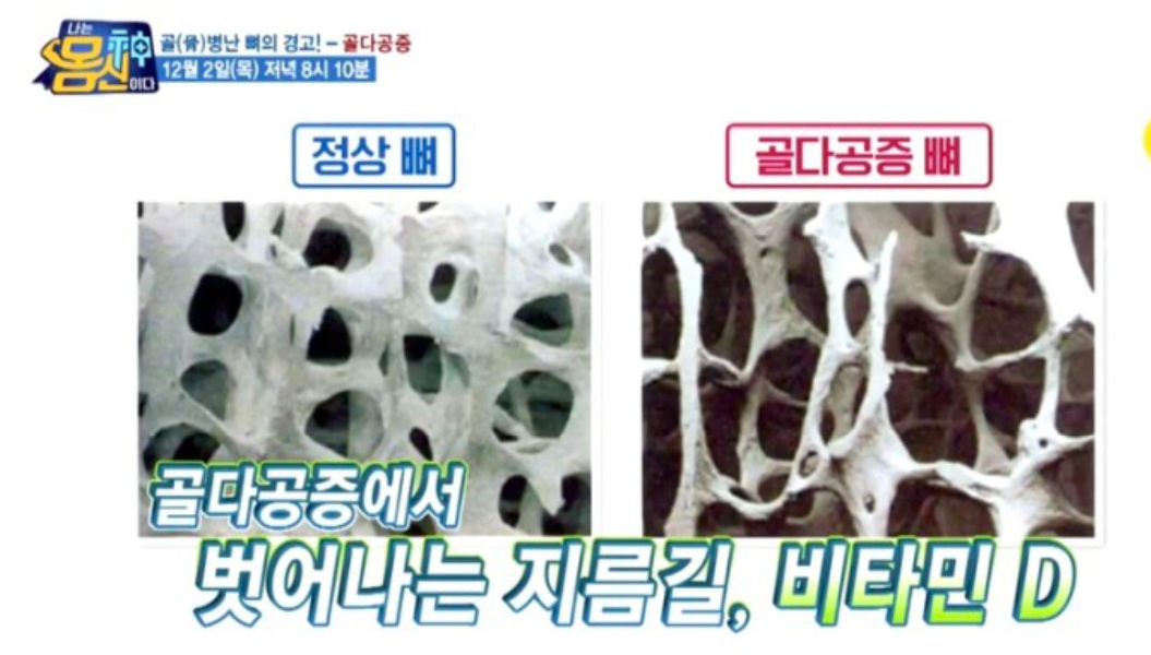  골다공증에좋은식품음식 뼈보약흑차레시피 고관절골절예방 비타민D효능추천 골밀도강화1분벽스쾃하체근력키우는운동 나는몸신이다 360회 1202