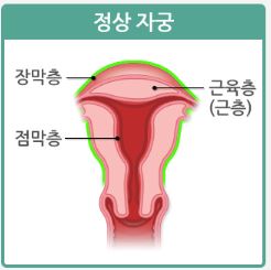 자궁근종 이란