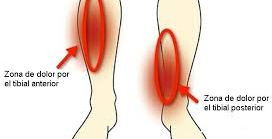 종아리가아픈이유-경골골막염
