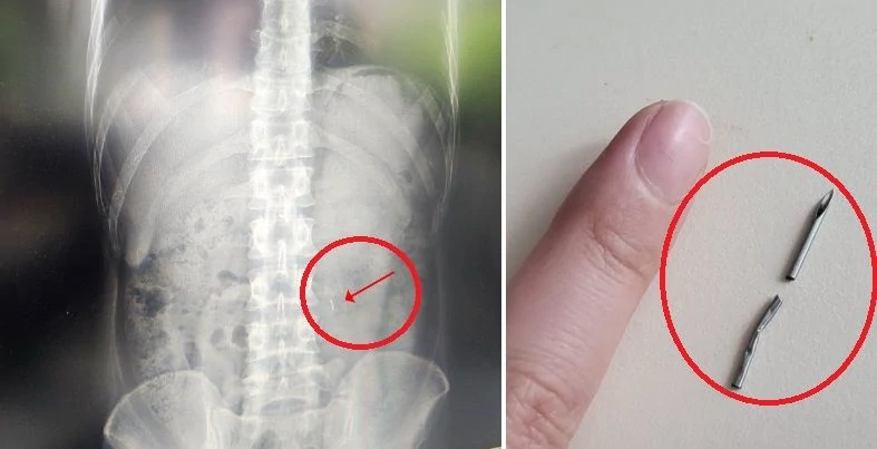 한우 먹다가 주삿바늘 발견?! 충격적인 경험담