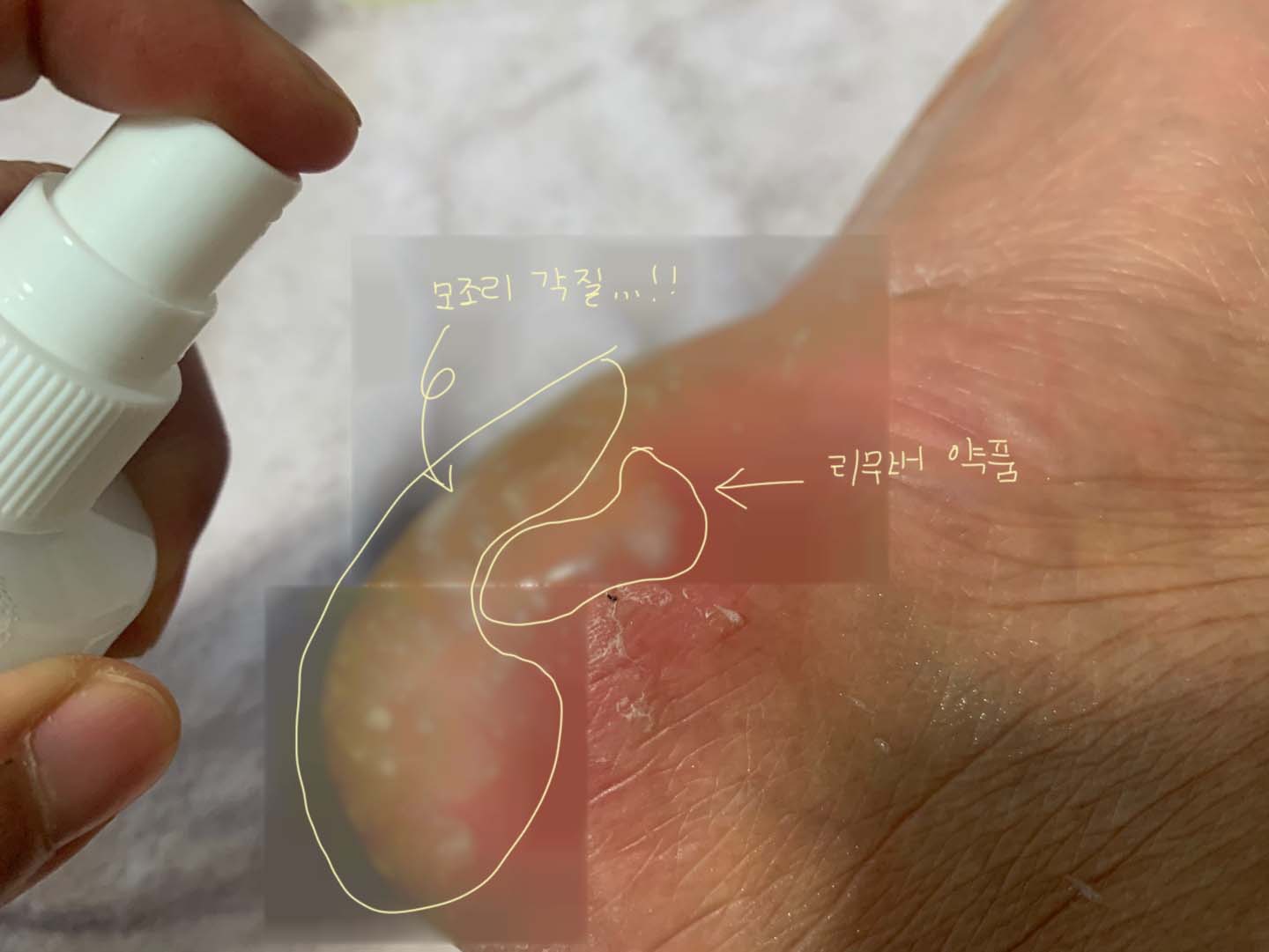 다이소 발 각질 제거제(리무버), 저렴한데 이 정도 효과가~? - undefined - 다이소 '발 각질 리무버' 사용 후기 다이소 발 각질 제거제(리무버), 저렴한데 이 정도 효과가~? - undefined - 다이소 '발 각질 리무버' 사용 후기