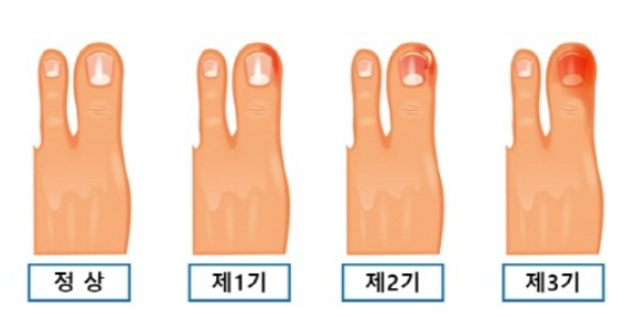 내성발톱 기수