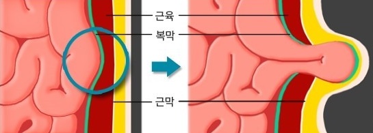  탈장 원인 및 증상, 치료 방법, 합병증 입니다.