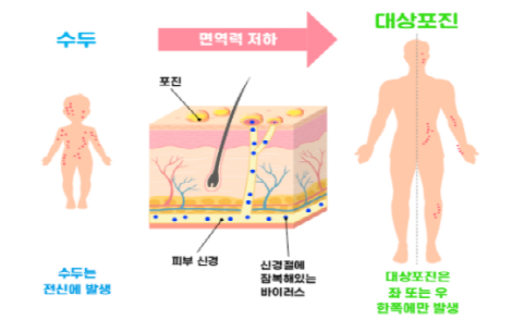 대상포진 발병 원인_출처: 네이버 블로그