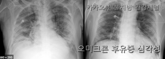  오미크론 위증증 적다고? 경증 이후 후유증 심각하다.