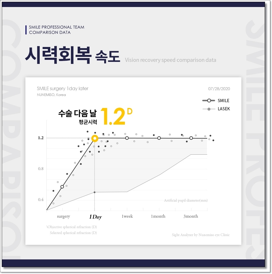 라섹회복기간 1일 2