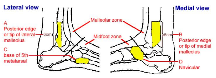 발목 골절 테스트 시 통증이 발생할 수 있는 부위 4곳을 표시 해놓고 설명하는 그림.