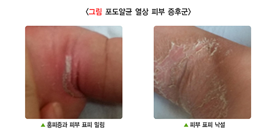  소아발진