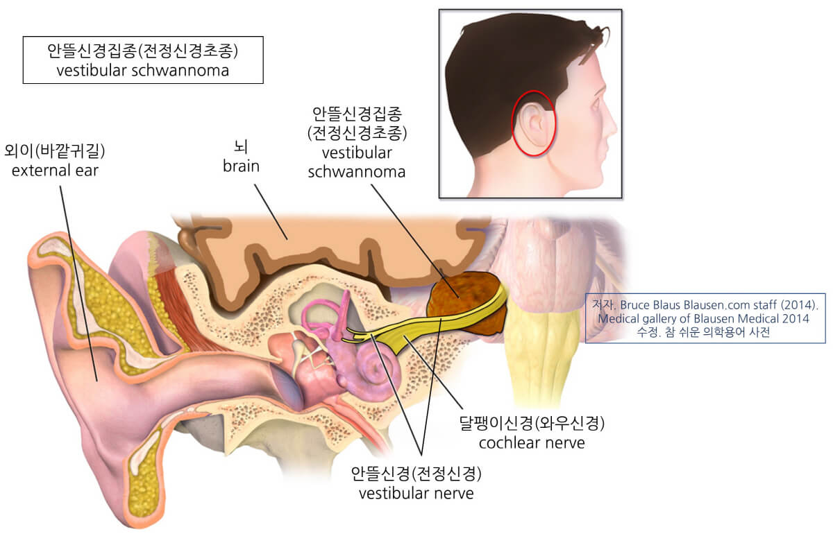vestibular schwannoma 안뜰신경집종, 전정신경초종의 모양