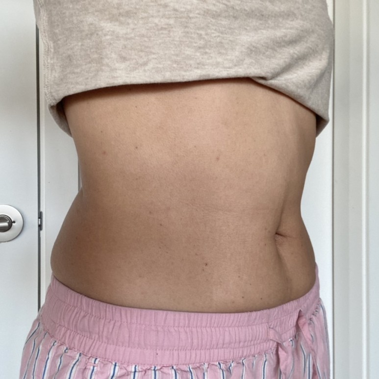 한달째 배살빼는법 실행결과 복부지방분해주사 - 8