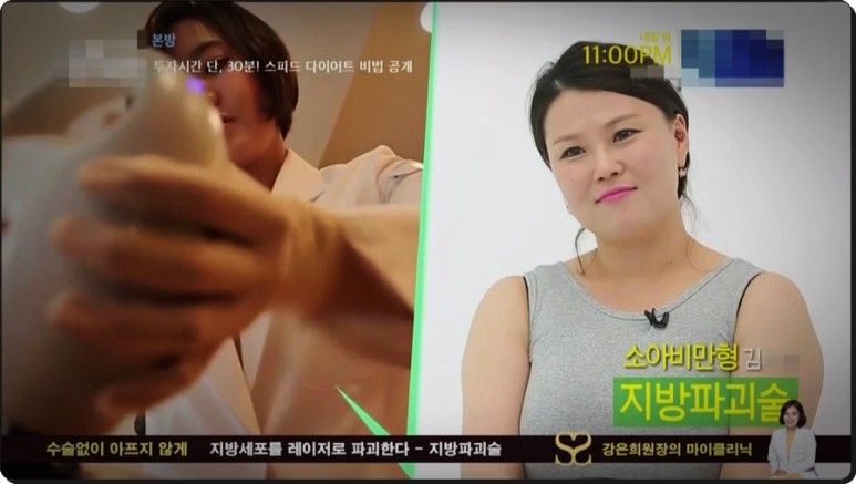 셀룰라이트 제거까지 지방파괴술 효과, 뱃살 다이어트부터 복부 20