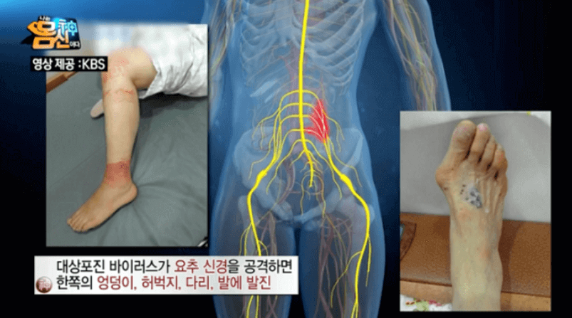 하체-신경절-대상포진