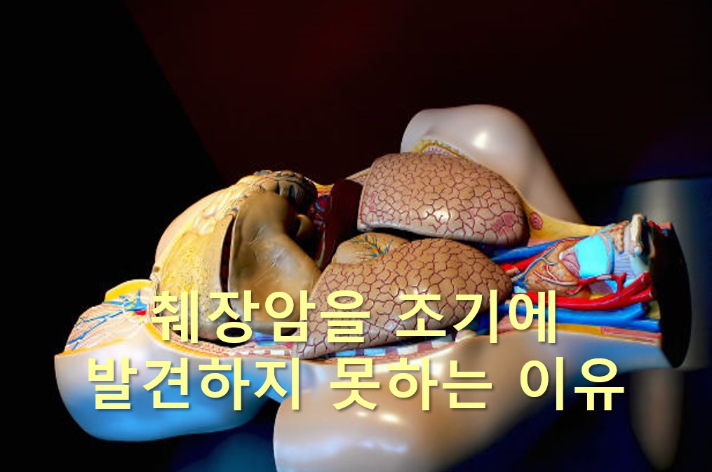 췌장암을 조기에 발견하지 못하는 이유