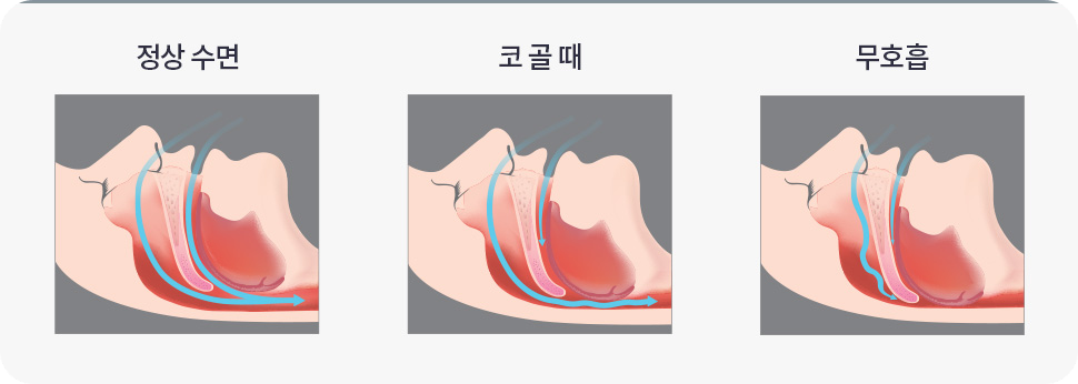 코골이수술비용베개2