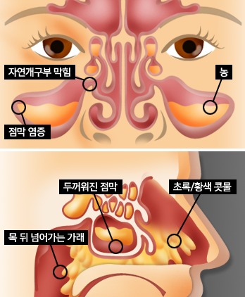  축농증 이렇게 치료하세요 비염