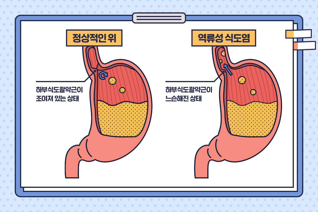  "속쓰림을 멈춰라: 역류성 식도염 관리법"