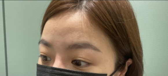 이마필러잘하는곳 후기! 10