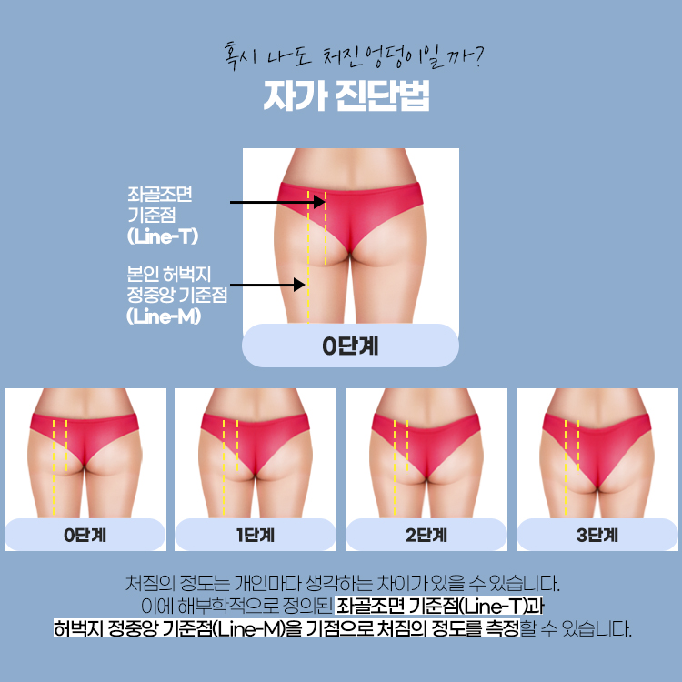 처짐의 정도는 개인마다 생각하는 차이가 있을 수 있습니다. 이에 해부학적으로 정의된 좌골조면 기준점과 허벅지 정중앙 기준점을 기점으로 처짐의 정도를 측정할 수 있습니다.