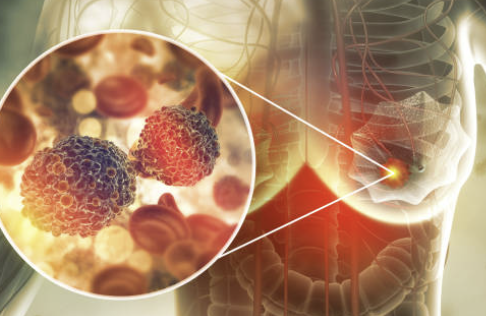 유방암 수술 후 회복 기간