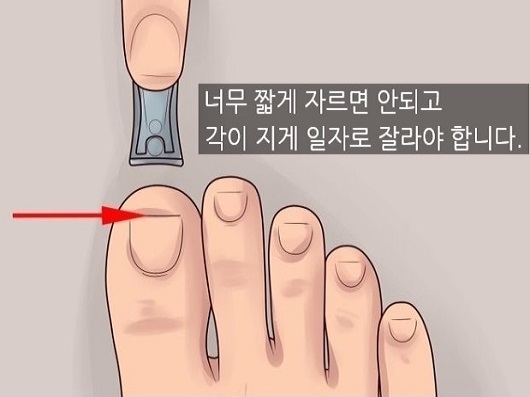  내성발톱 원인 및 자가치료  방법 총정리