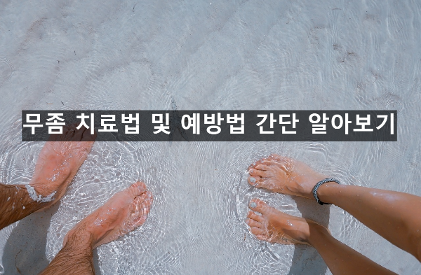  무좀 치료법 및 예방법 간단 알아보기