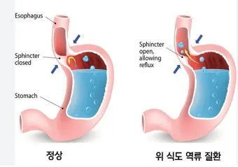 역류성 식도염 원인 초기증상 예방하는 방법_6