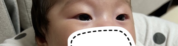  D+159, 눈물 고임 증상 완화!