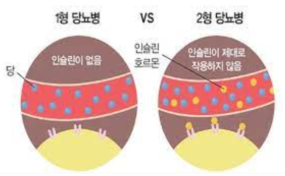 당뇨병의 초기 증상