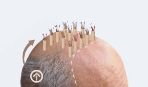 Grow Your Hair with Proper Care: Understanding the Post-Hair Transplant Phase.