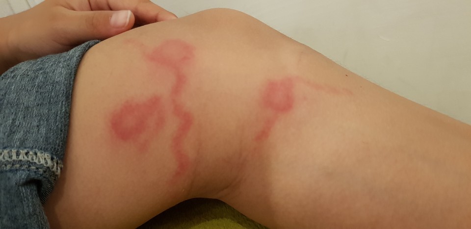 독이 있는 해충 화상벌레에 물렸을 때 생기는 일 독이 있는 해충 화상벌레에 물렸을 때 생기는 일