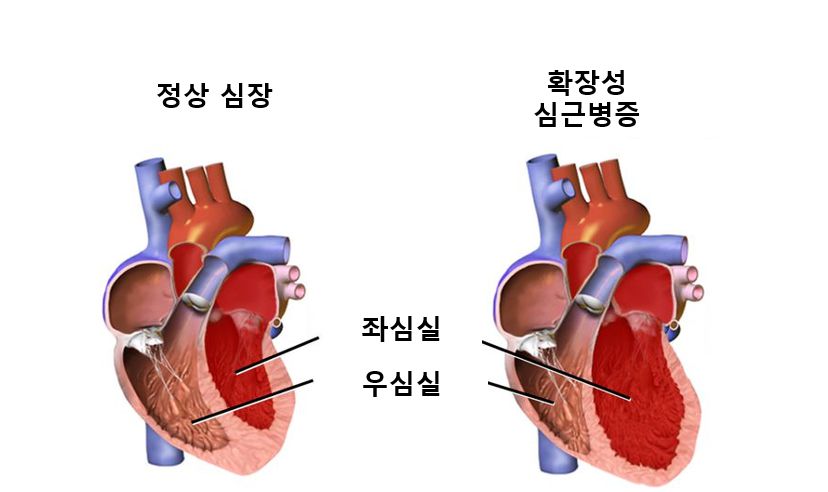 심근병증 설명 그래픽