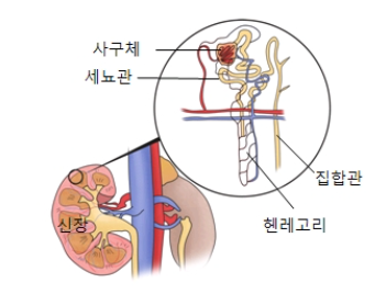  만성신부전 증상 과 원인