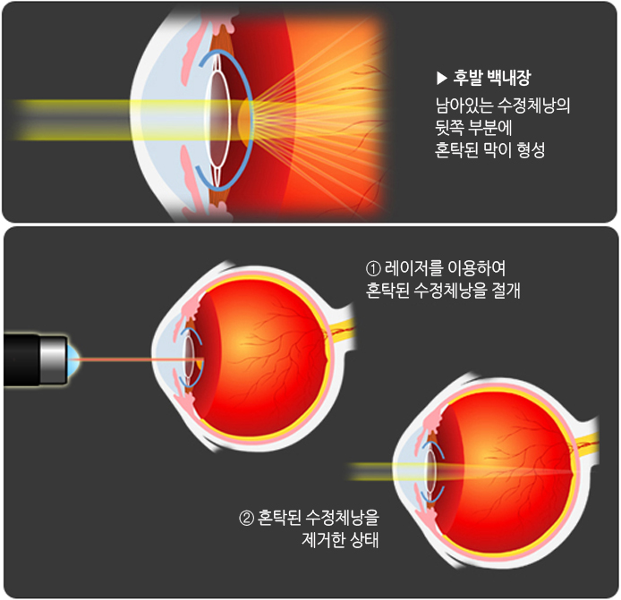  [질병후기] 후발성백내장 수술후기