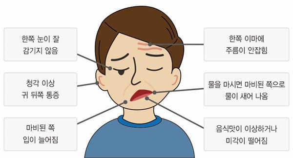  안면마비, 스트레스 + 심신 지치면 통증없이 찾아온다는 흔한 질병.jpg