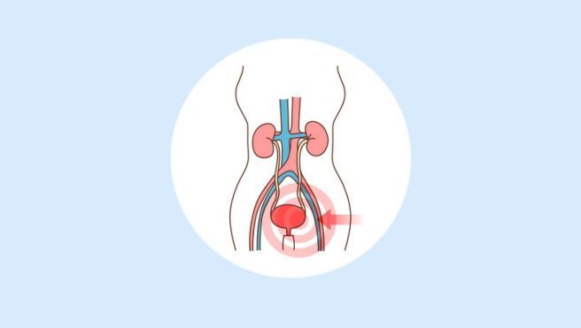 과민성 방광 치료방법 원인과 수술 증상