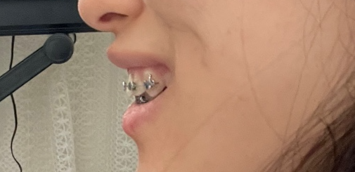 앞니 부분교정 다섯번째 후기