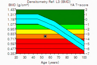 골다공증 수치보는법