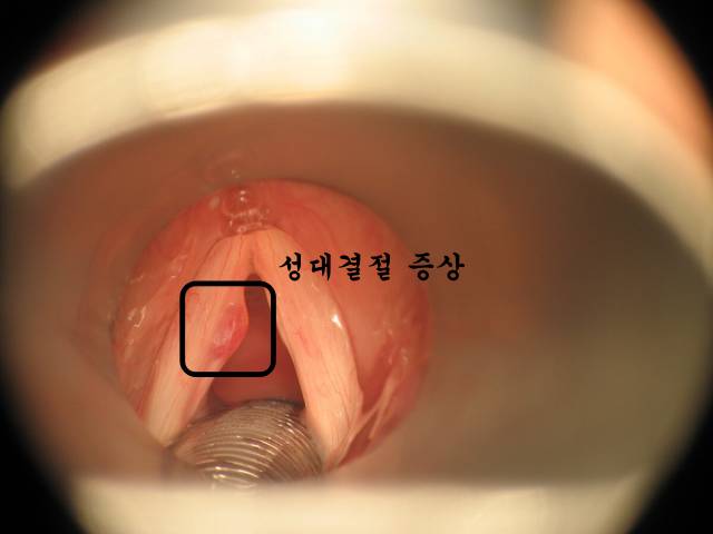 성대결절 사진