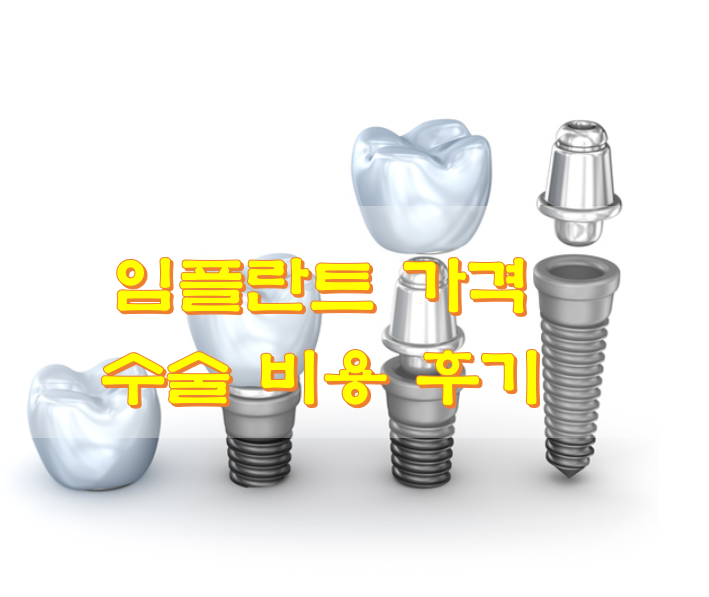  임플란트 가격 수술 비용 후기