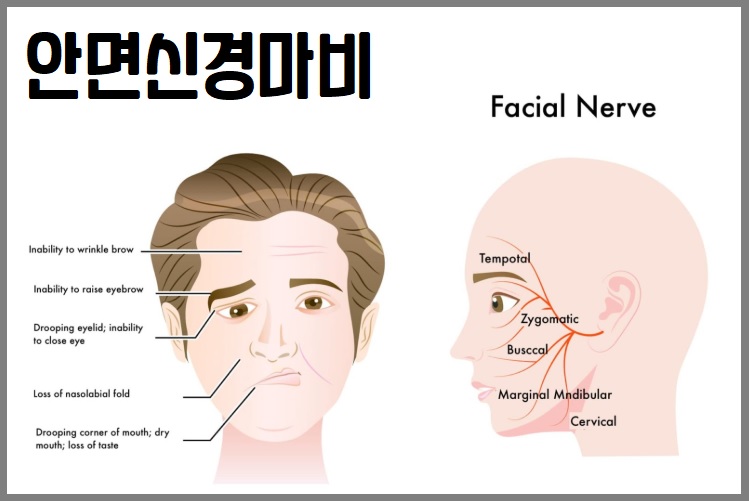 안면신경마비