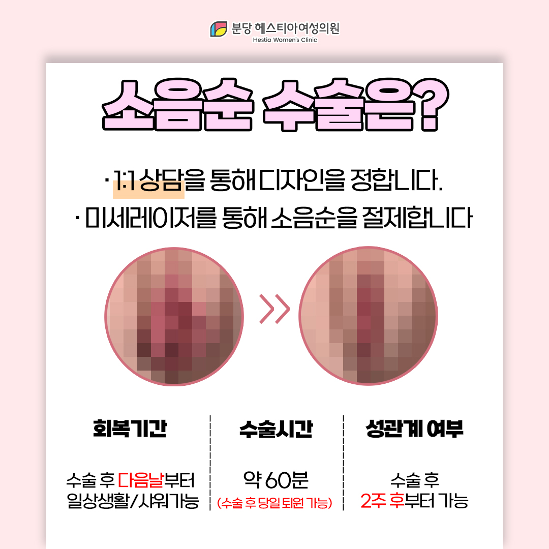 죽전산부인과 늘어난 소음순 여성 생식기 악취 소음순 수술에 대해서