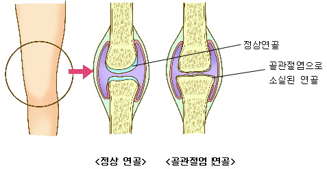 뼈 연골