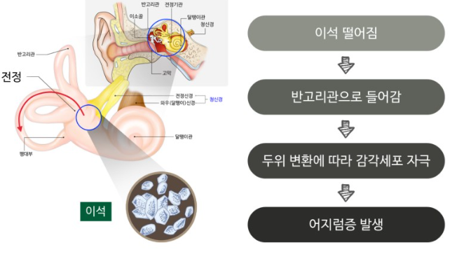 이석증-원인